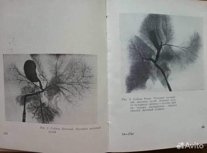 Отдаленные результаты хирургич.леч. холециститов