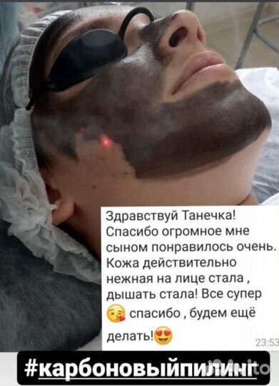 Карбоновый пилинг