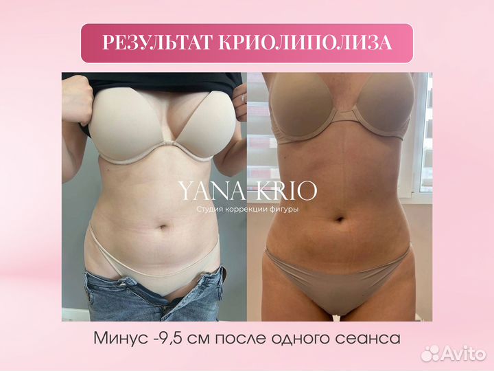 Криолиполиз LPG Массаж Эпиляция - коррекция фигуры