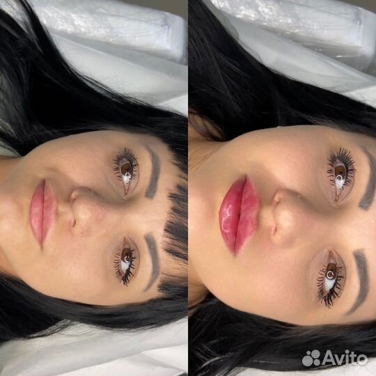 Увеличение губ