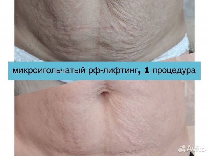 Микроигольчатый RF лифтинг лица и тела