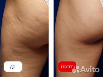 LPG массаж тела. Гуаша. Качественно. В центре