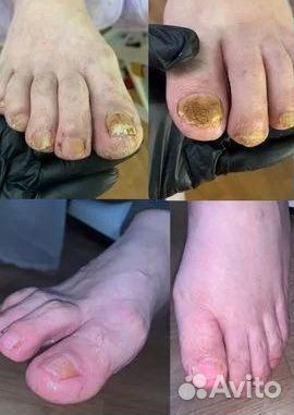 Медицинский педикюр, подолог