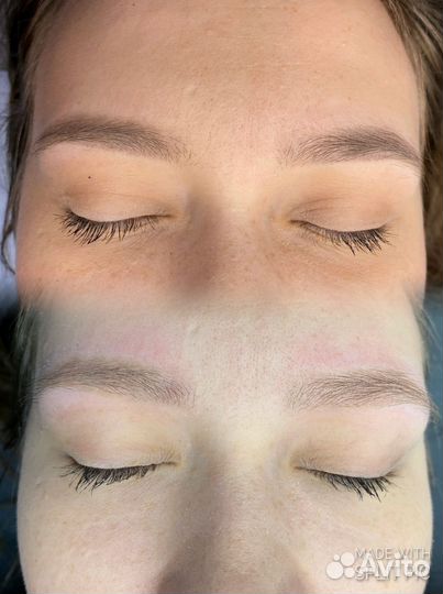 Удаление татуажа