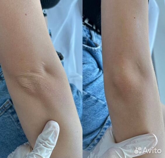 Модель на лифтинг аппаратом Ультраформер 3