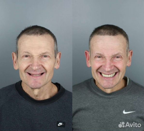 Съемные зубные протезы