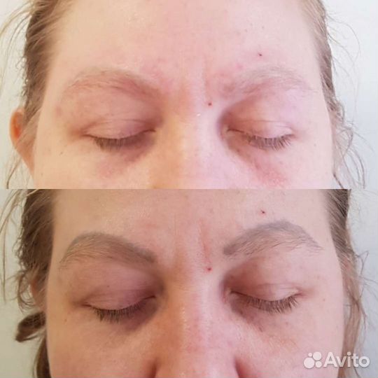 Удаление татуажа лазером