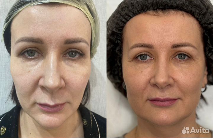 Биоревитализация мезотерапия губы