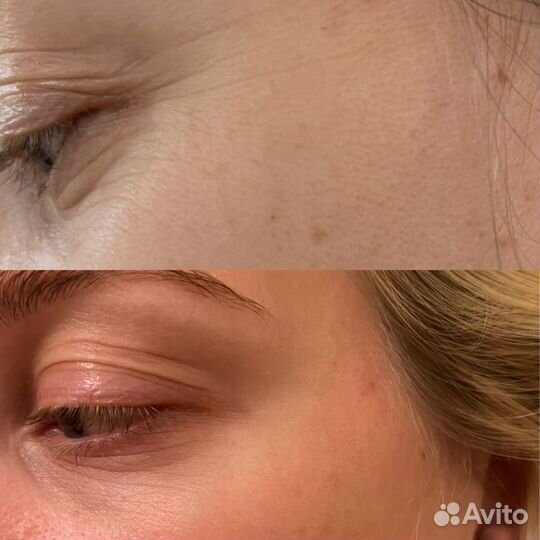 Контурная пластика губ