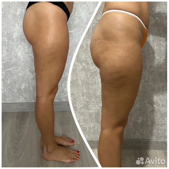 Массаж антицеллюлитный,лимфодренажный,буккальный