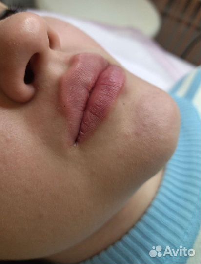 Увеличение губ