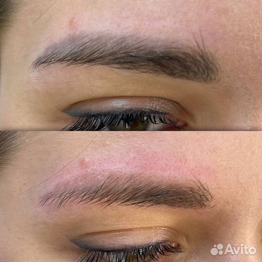 Удаление татуажа и удаление тату