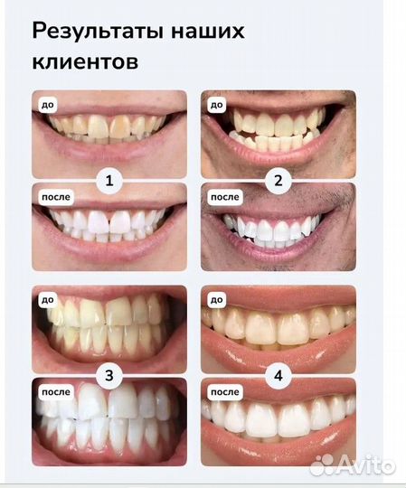 Набор для отбеливания зубов