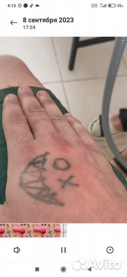 Лазерное удаление тату, перманента