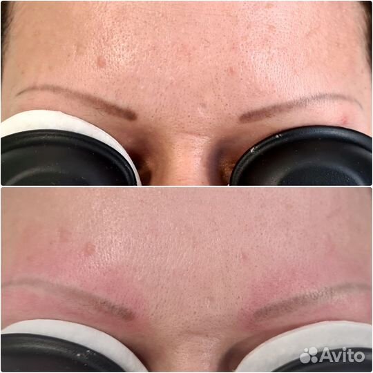 Удаление татуажа. Удаляем стрелки