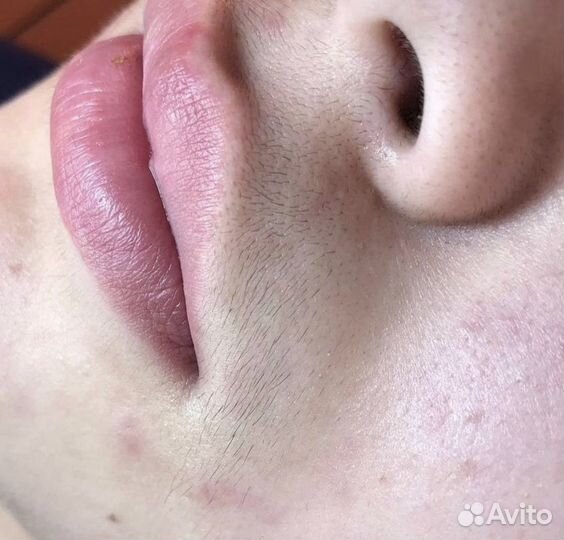 Электроэпиляция