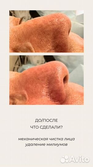 Косметолог Чистка лица Аппаратная косметология