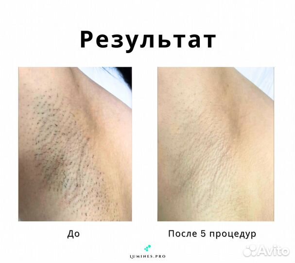 Диодный лазер для эпиляции Люминес’ Макс Ван 1200 Вт