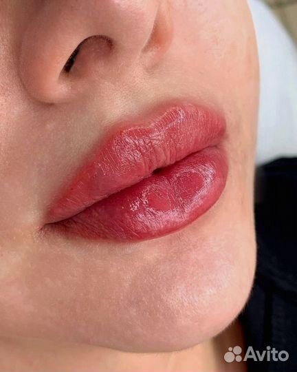 Контурная пластика губ