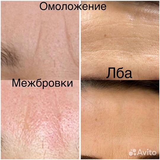 Безоперационная блефаропластика