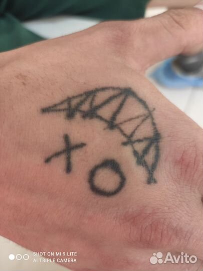 Лазерное удаление тату, перманента