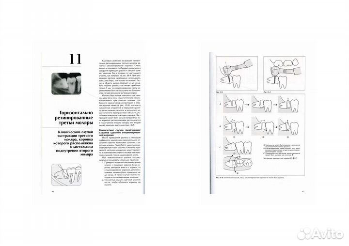 Квалифицированное удаление третьих моляров