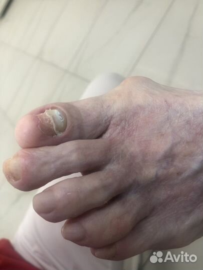 Подолог.Вросший ноготь