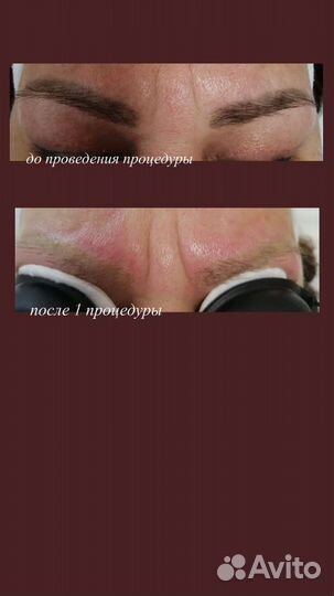 Удаление перманентного макияжа и тату