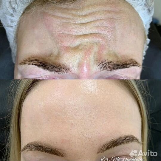 Коррекция морщин. Ботокс