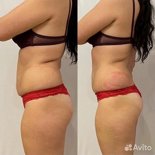 Криолиполиз + миостимуляция