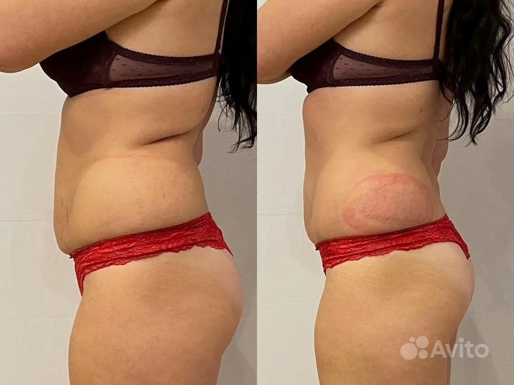 Cryolipolysis - Lux Medicus