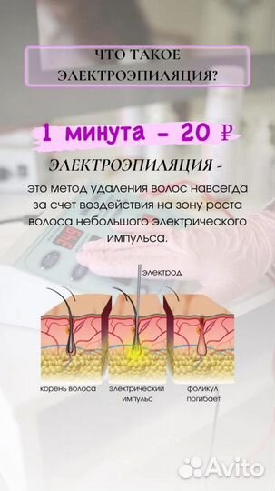 Электроэпиляция