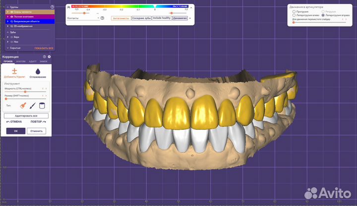 Моделировка в Exocad