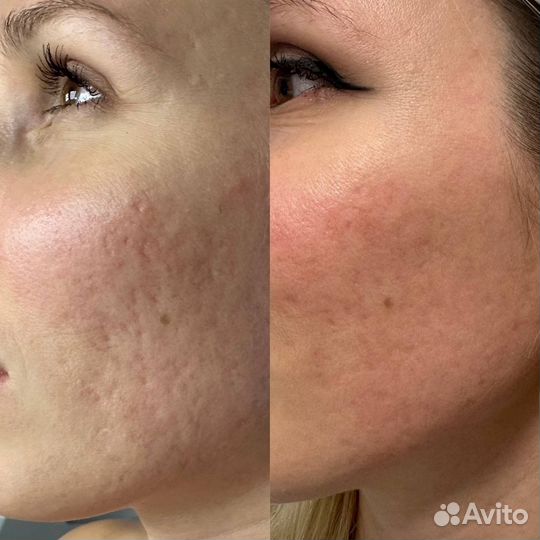 Лечение рубцов