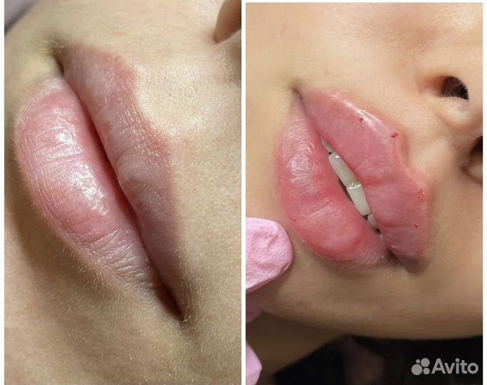 Увеличение губ