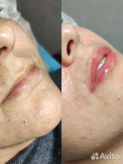 Биоревитализация