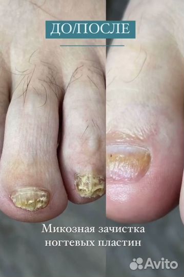 Педикюр для лежачих, уход за ногами на дому