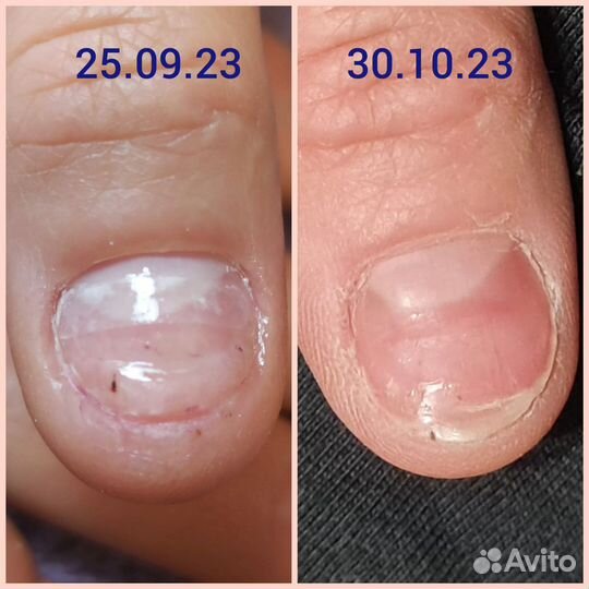 Подология, педикюр