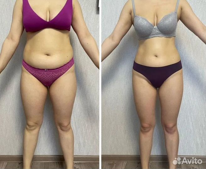 Плоский живот - размер за 1 процедуру