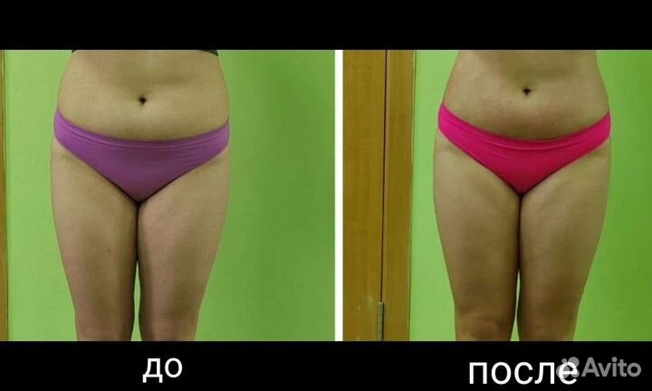 LPG массаж, кавитация, rf