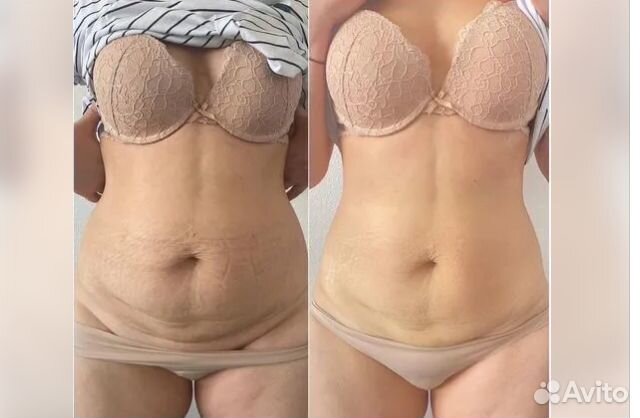 Плоский живот - размер за 1 процедуру в Казани