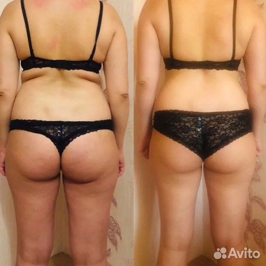 LPG массаж - целлюлита как и не бывало