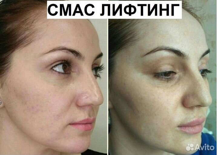 СМАС лифтинг для лица