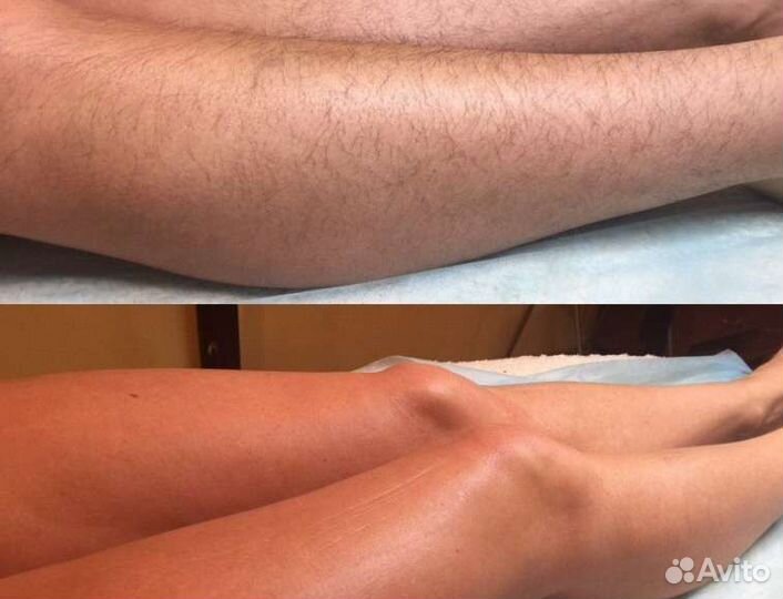 Эпиляция шугаринг
