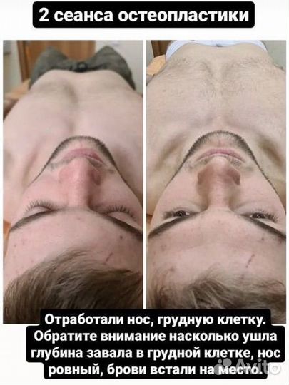 Массаж Остеопластика (остеопатический)