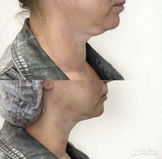 Смас лифтинг