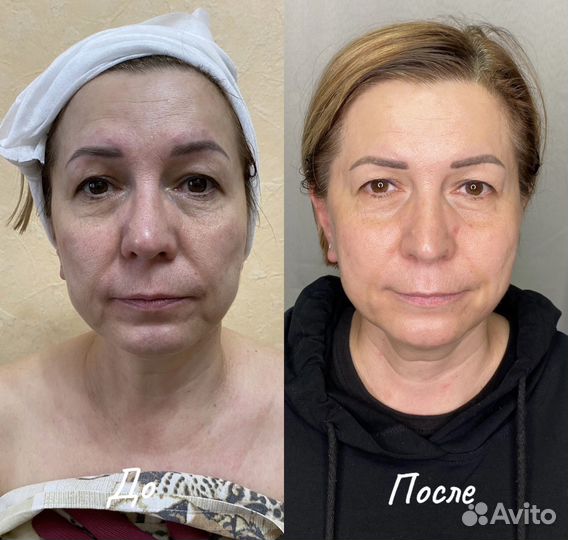 Обучение ret cet индиба indiba