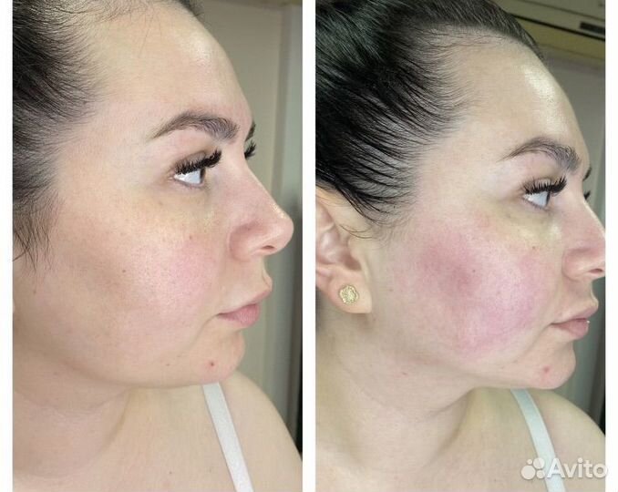 Смас лифтинг