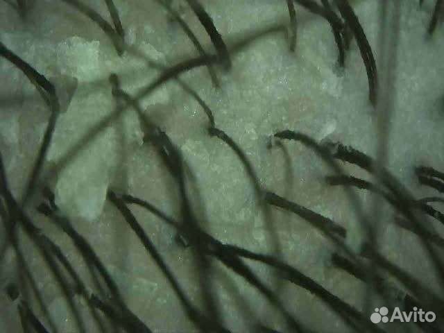 Пилинг кожи головы