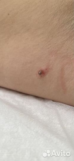 Удаление папилломы